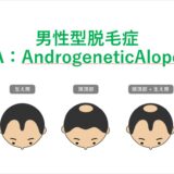 男性型脱毛症（AGA：AndrogeneticAlopecia）
