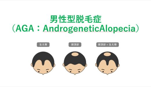 男性型脱毛症（AGA：AndrogeneticAlopecia）
